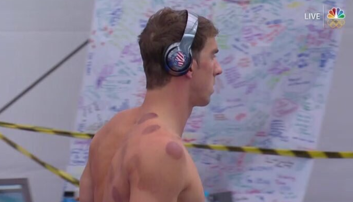 Michael Phelps after doing cupping therapy.