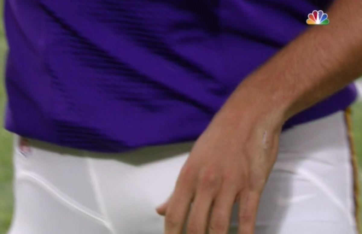 A closeup picture of Sam Bradford's hand.