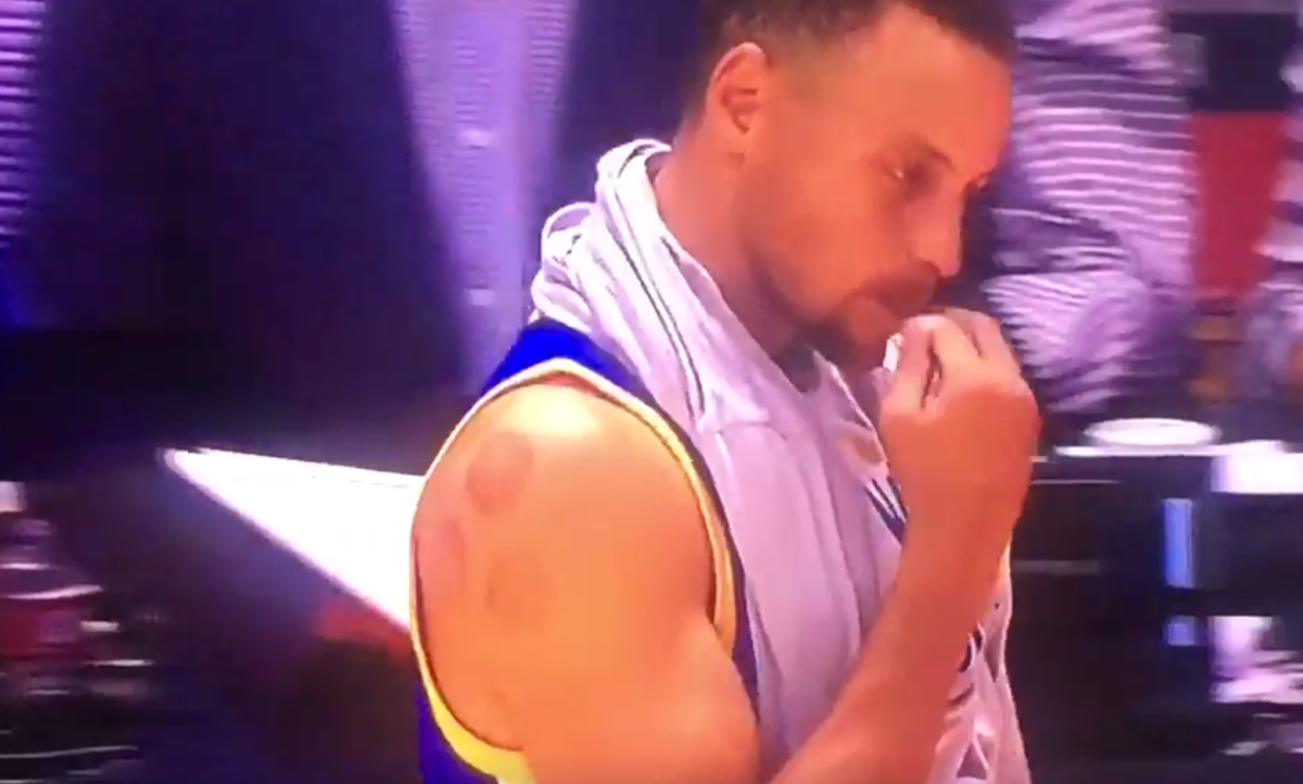Stephen Curry with cupping marks on his right shoulder.