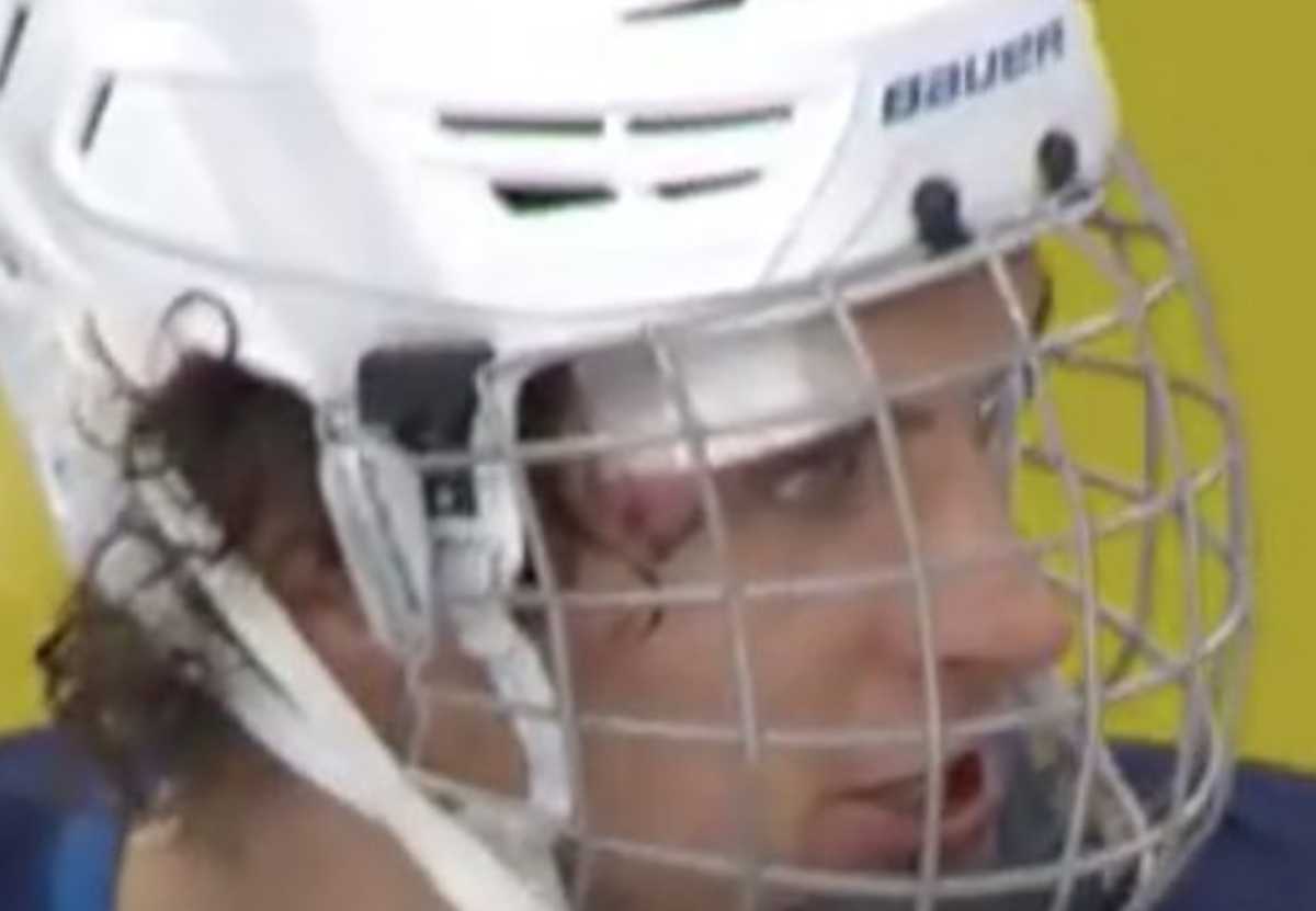 look-nhl-player-receives-75-stitches-after-skate-to-face-comes-back